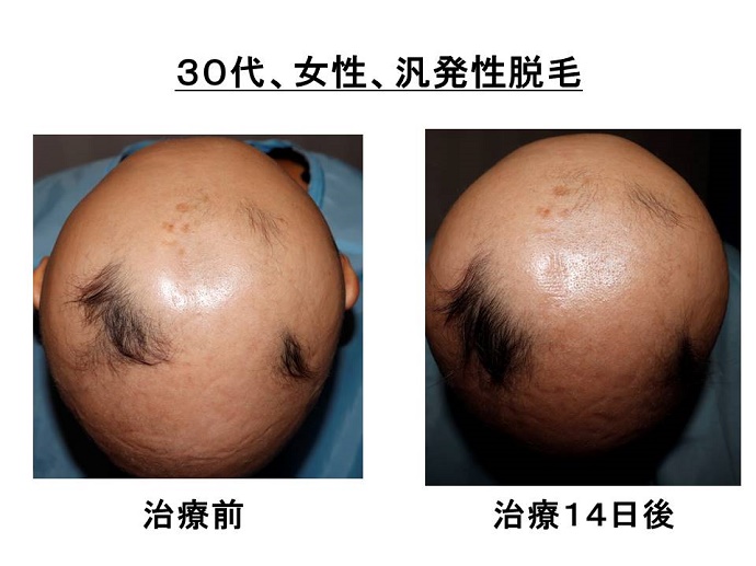 円形脱毛症　病院
